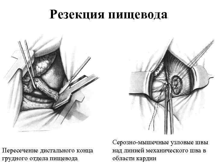 Резекция пищевода Пересечение дистального конца грудного отдела пищевода Серозно мышечные узловые швы над линией