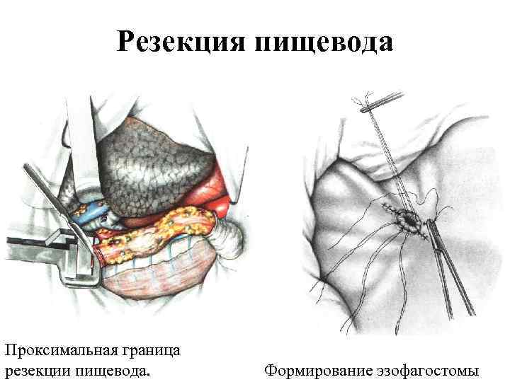 Операции на грудной стенке