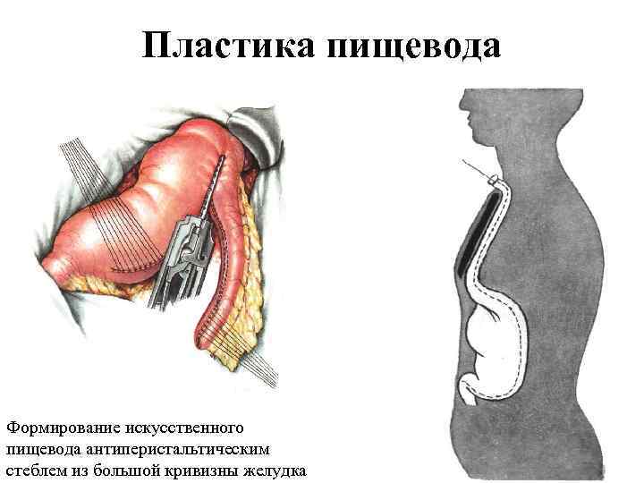 Пластика грудных желез фото