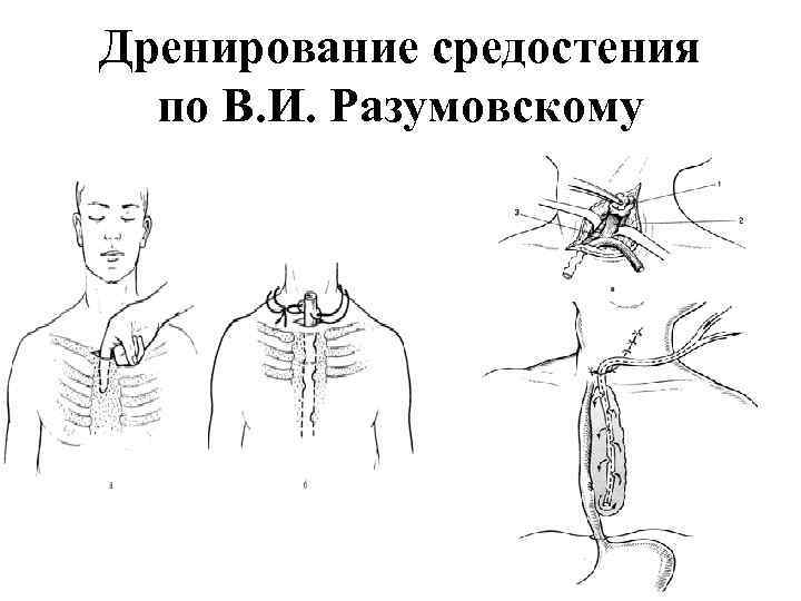 Дренирование средостения по В. И. Разумовскому 