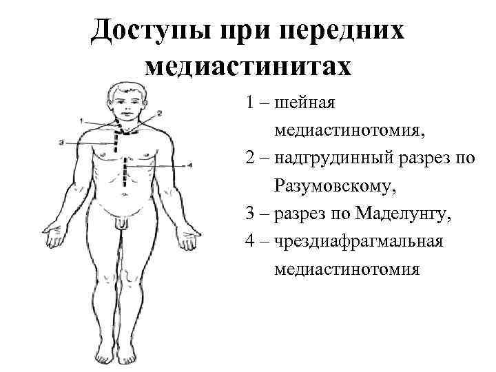 Доступы при передних медиастинитах 1 – шейная медиастинотомия, 2 – надгрудинный разрез по Разумовскому,