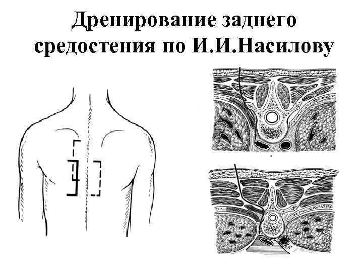 Дренирование заднего средостения по И. И. Насилову 