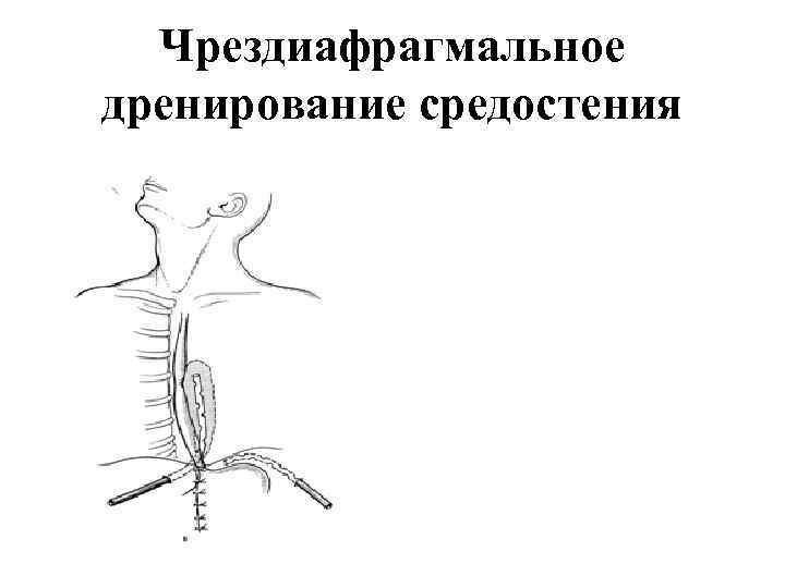 Чрездиафрагмальное дренирование средостения 