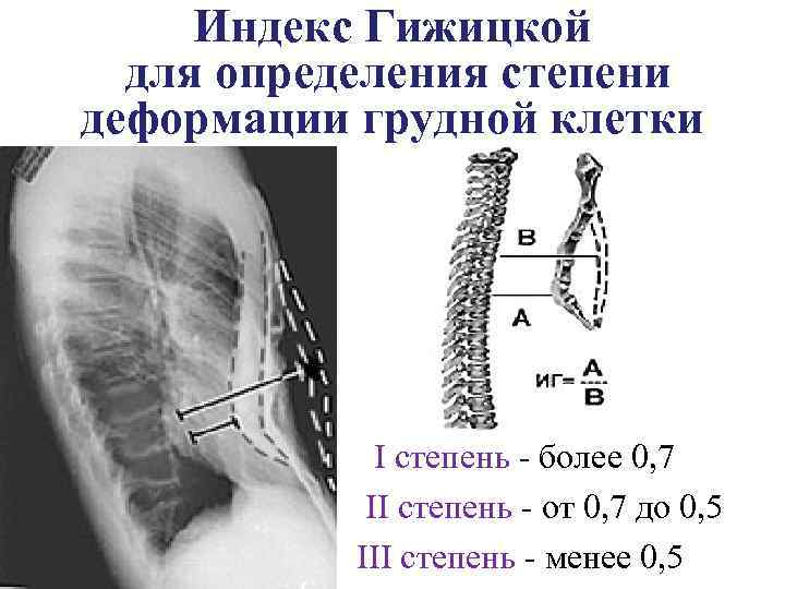 Топографическая анатомия грудной клетки презентация