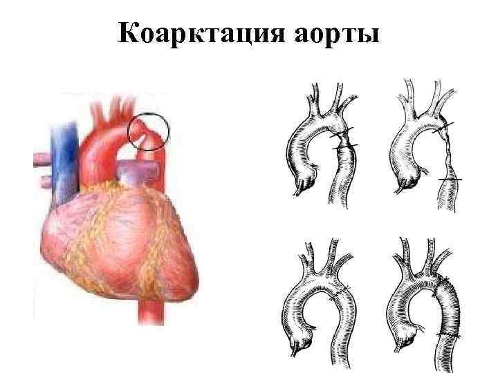 Коарктация аорты 