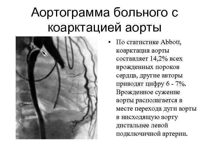 Аортограмма больного с коарктацией аорты • По статистике Abbott, коарктация аорты составляет 14, 2%