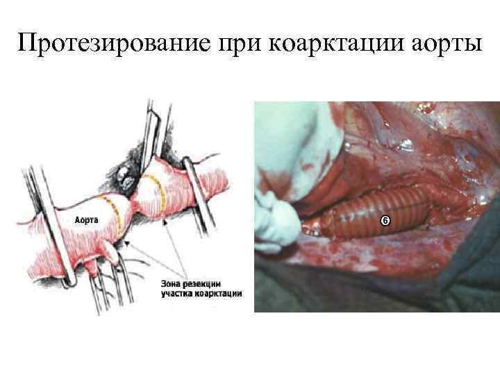 Протезирование при коарктации аорты 