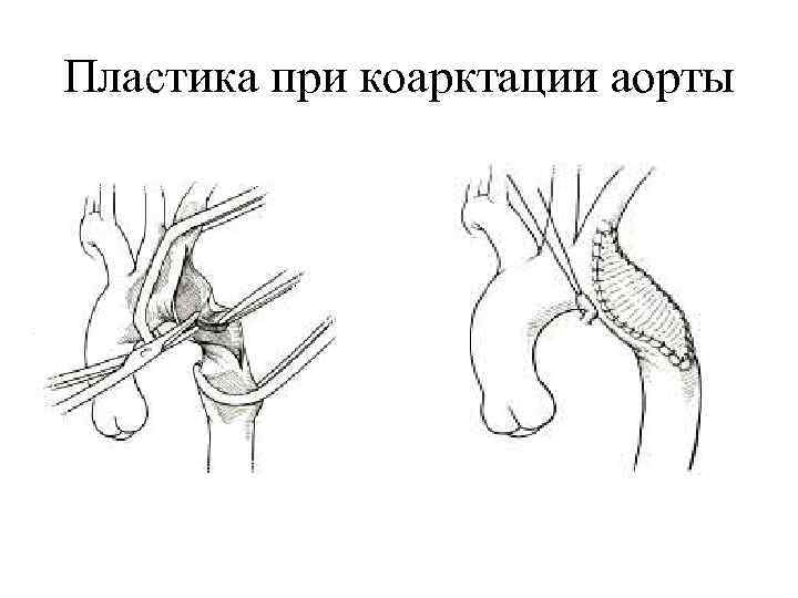 Операции на грудной стенке