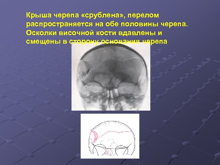 Крыша черепа «срублена» , перелом распространяется на обе половины черепа. Осколки височной кости вдавлены