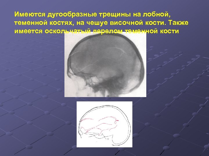 Линейная трещина. Оскольчатый перелом чешуи лобной кости. Линейный перелом височной кости.