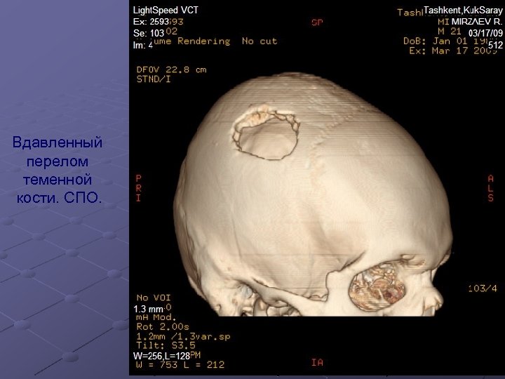 Вдавленный перелом теменной кости. СПО. 
