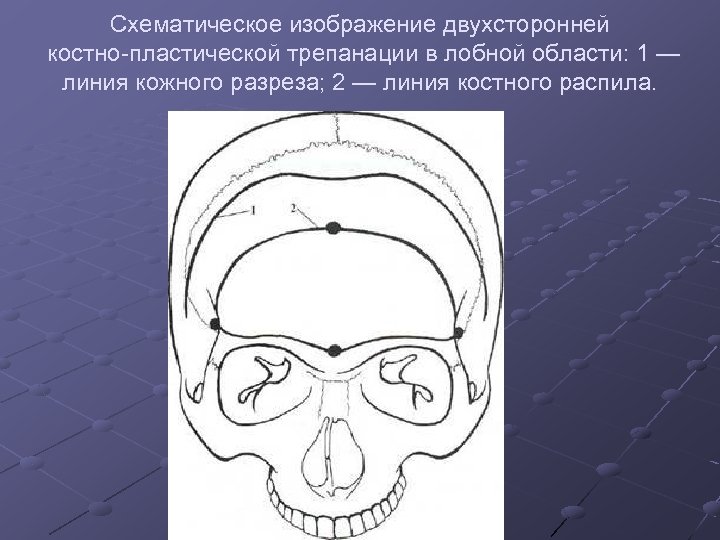 Схематическое изображение двухсторонней костно пластической трепанации в лобной области: 1 — линия кожного разреза;