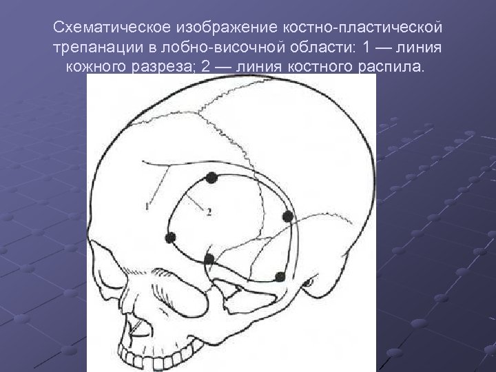 Способы трепанации. Костно-пластическая Трепанация черепа. Костно пластическая Трепанация черепа по Вагнеру Вольфу. Костнопластическая Трепанация черепа по Вагнеру-Вольфу и Оливекрону. Костно-пластическая Трепанация по Оливекрону.