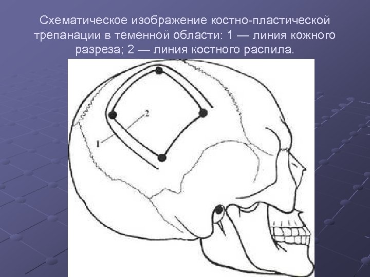 Схематическое изображение костно пластической трепанации в теменной области: 1 — линия кожного разреза; 2