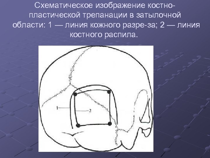 Схематическое изображение костно пластической трепанации в затылочной области: 1 — линия кожного разре за;