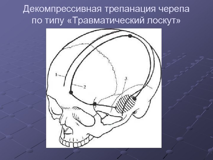 Схема трепанации черепа по способу оливекрона