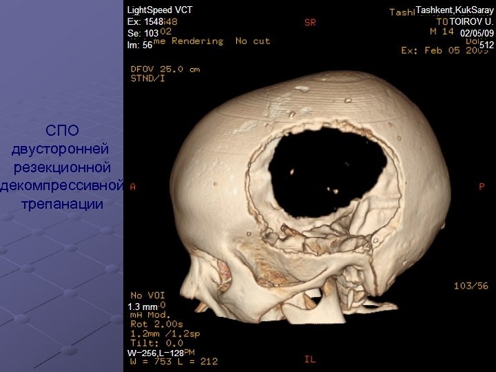 СПО двусторонней резекционной декомпрессивной трепанации 