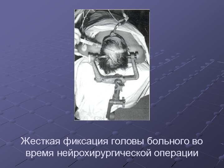 Жесткая фиксация головы больного во время нейрохирургической операции 