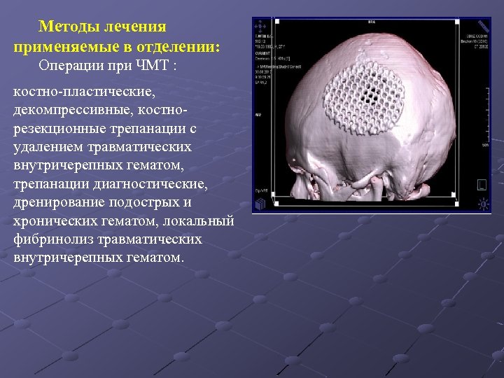 Методы лечения применяемые в отделении: Операции при ЧМТ : костно-пластические, декомпрессивные, костнорезекционные трепанации с