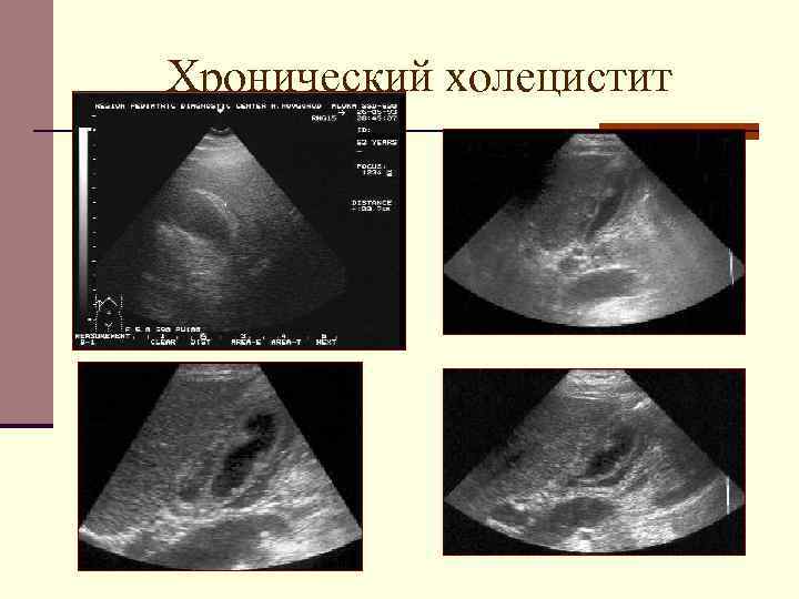 Хронический холецистит 