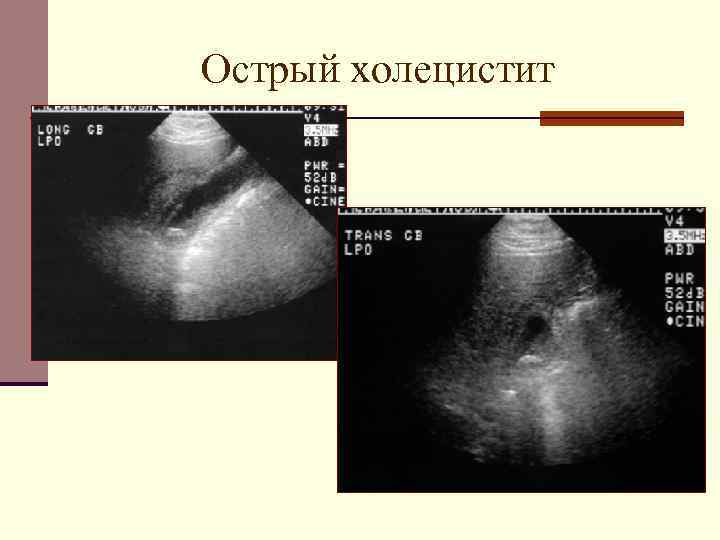 Для эхографической картины острого холецистита характерно тест ответ