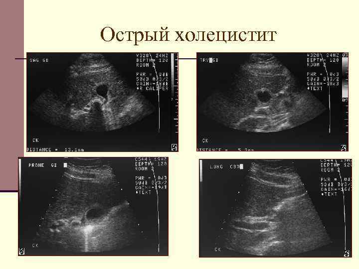 Острый холецистит 