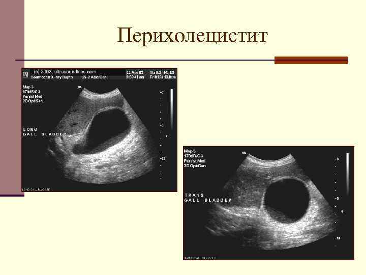 Перихолецистит 