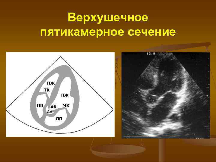 Верхушечное пятикамерное сечение ПЖ ТК ЛЖ ПП АК Ао ЛП МК 