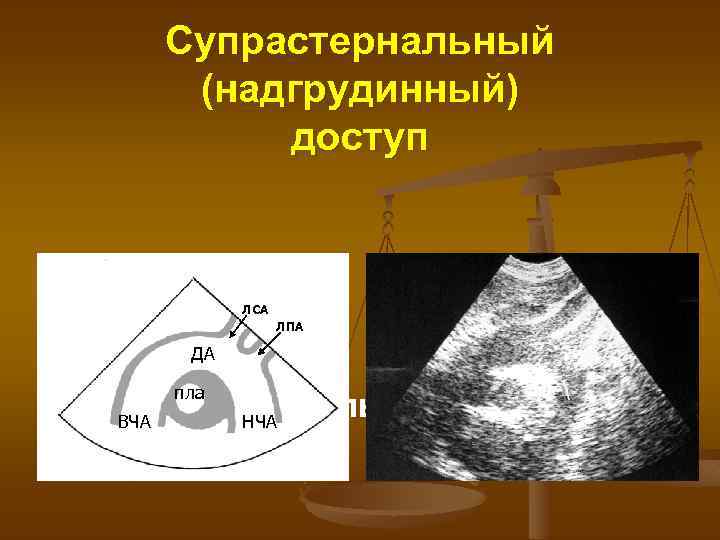 Супрастернальный (надгрудинный) доступ ЛСА ЛПА ДА пла Супрастернальное сечение НЧА ВЧА 