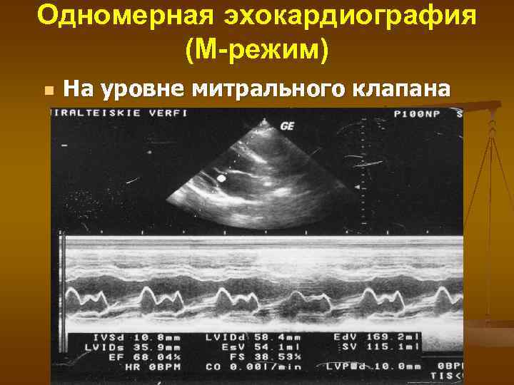 Одномерная эхокардиография (М-режим) n На уровне митрального клапана 