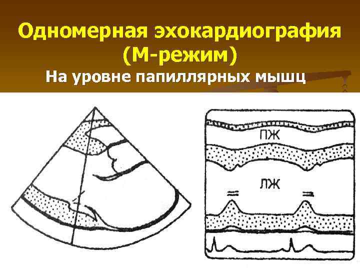 Одномерная эхокардиография (М-режим) На уровне папиллярных мышц 