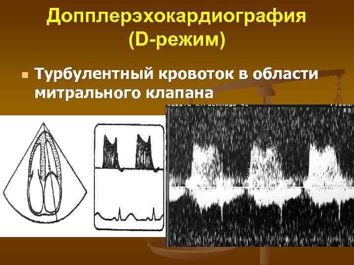 Допплерэхокардиография (D-режим) n Турбулентный кровоток в области митрального клапана 