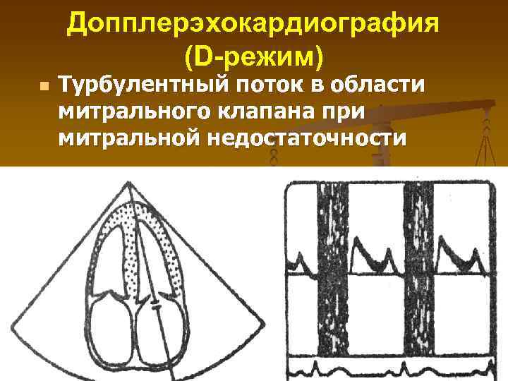 Допплерэхокардиография (D-режим) n Турбулентный поток в области митрального клапана при митральной недостаточности 