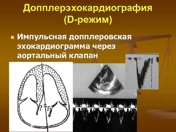 Допплерэхокардиография (D-режим) n Импульсная допплеровская эхокардиограмма через аортальный клапан 