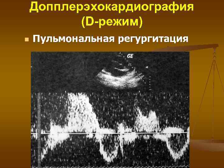 Допплерэхокардиография (D-режим) n Пульмональная регургитация 