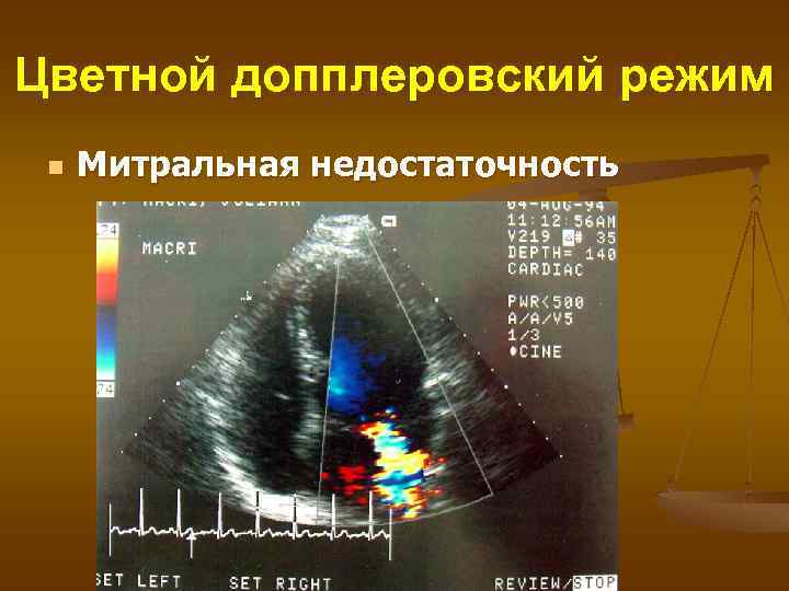 Цветной допплеровский режим n Митральная недостаточность 