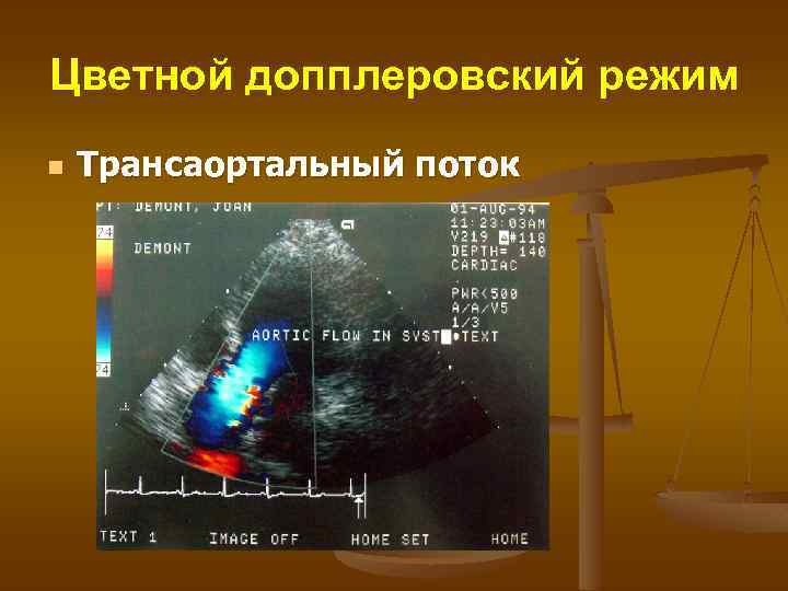 Цветной допплеровский режим n Трансаортальный поток 