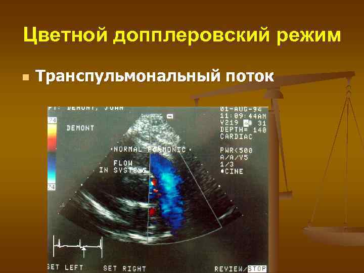 Цветной допплеровский режим n Транспульмональный поток 