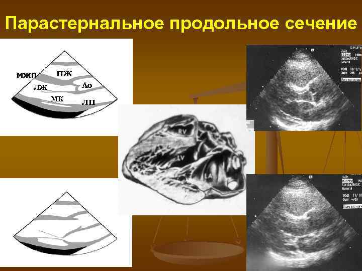 Парастернальное продольное сечение МЖП мжп ПЖ Ао ЛЖ МК ЛП 