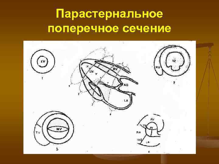 Парастернальное поперечное сечение 