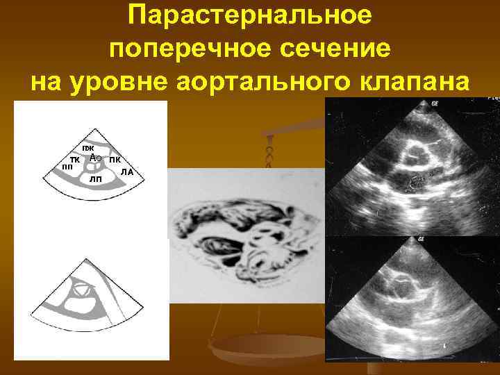 Парастернальное поперечное сечение на уровне аортального клапана ПЖ ТК ПП Ао ЛП ПК ЛА