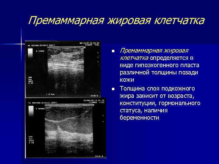 Премаммарная жировая клетчатка n n Премаммарная жировая клетчатка определяется в виде гипоэхогенного пласта различной