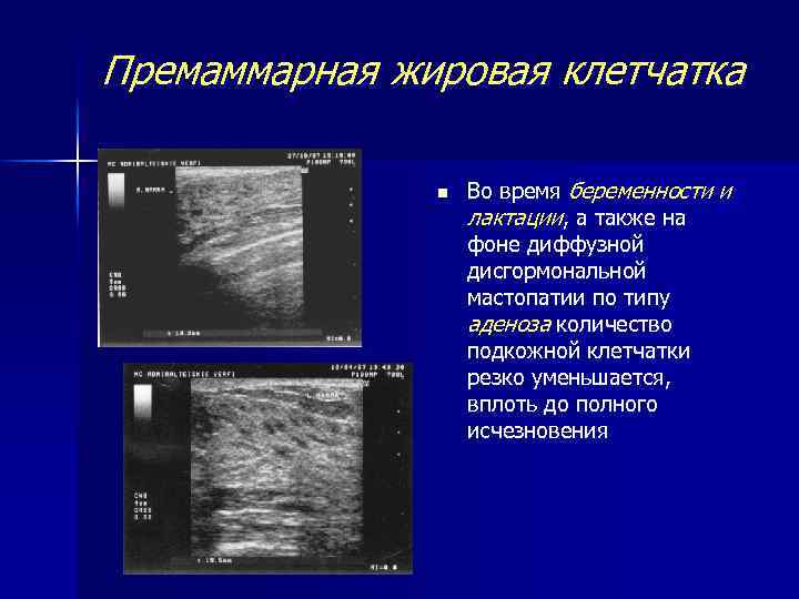 Премаммарная жировая клетчатка n Во время беременности и лактации, а также на фоне диффузной