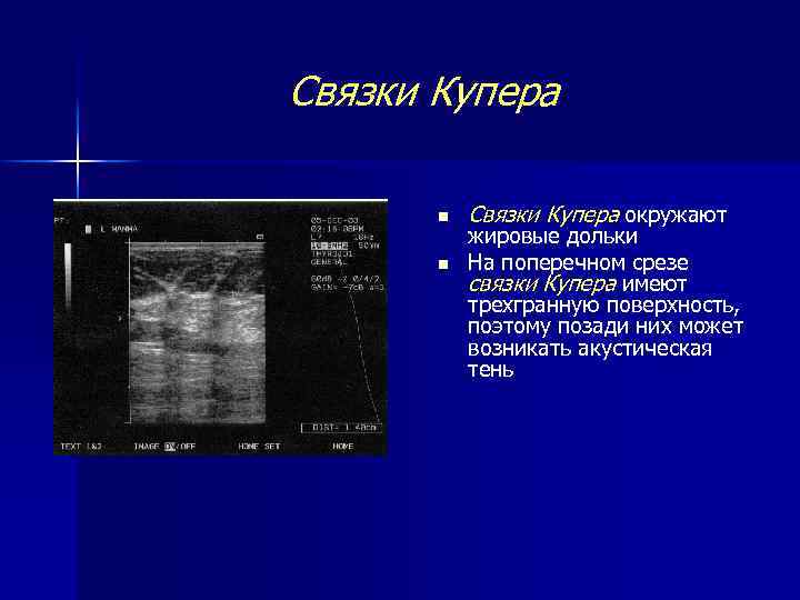 Связки Купера n n Связки Купера окружают жировые дольки На поперечном срезе связки Купера