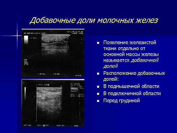 Как делают узи молочных желез у женщин фото