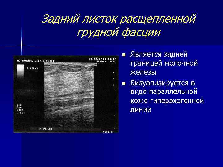 Задний листок расщепленной грудной фасции n n Является задней границей молочной железы Визуализируется в