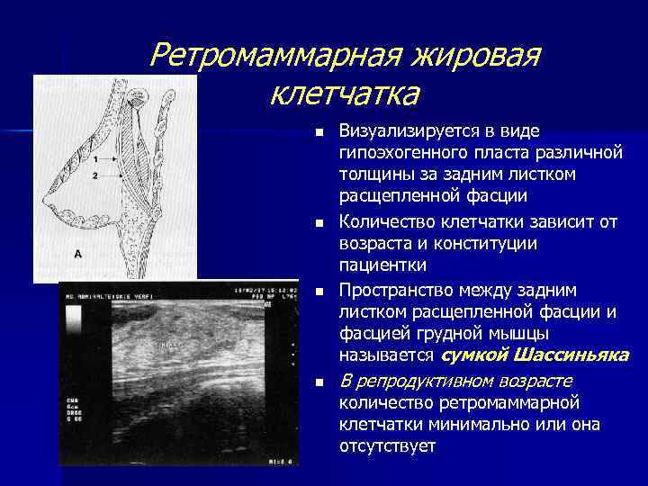 Ретромаммарная жировая клетчатка n n Визуализируется в виде гипоэхогенного пласта различной толщины за задним