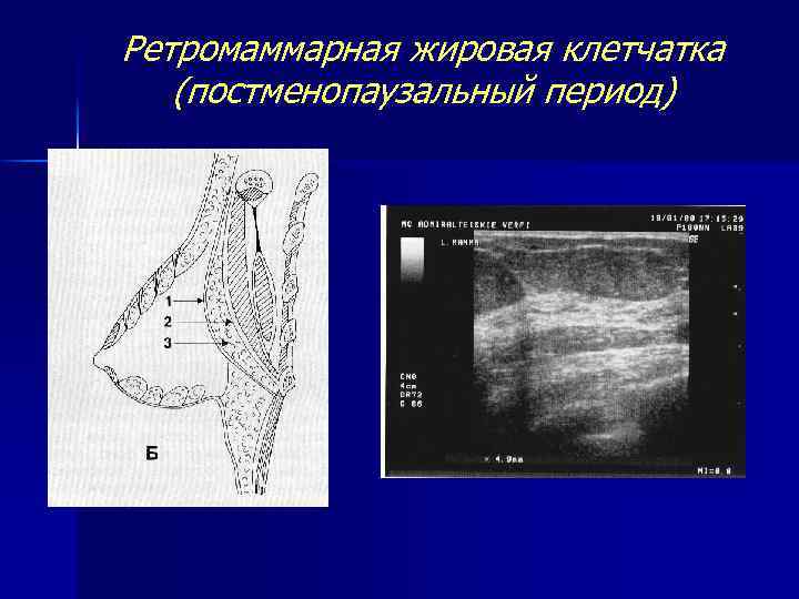 Ретромаммарная жировая клетчатка (постменопаузальный период) 