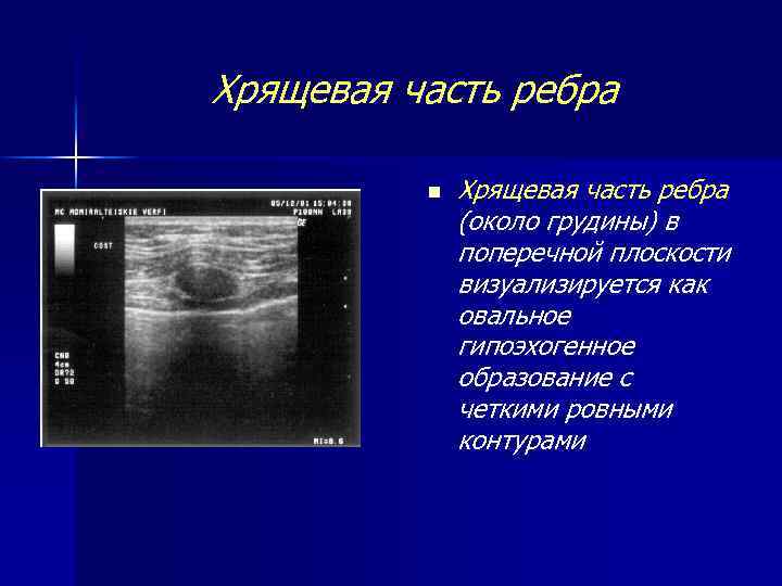 Хрящевая часть ребра n Хрящевая часть ребра (около грудины) в поперечной плоскости визуализируется как