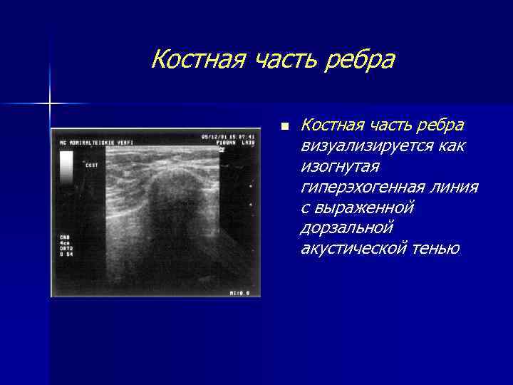 Симптом перилобулярного утолщения на компьютерных томограммах визуализируется как